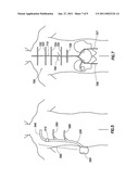 MULTIPLEXED MULTI-ELECTRODE NEUROSTIMULATION DEVICES diagram and image