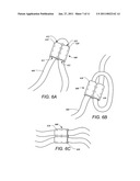 TUBULAR LEAD ANCHOR AND METHODS AND DEVICES USING THE ANCHOR diagram and image