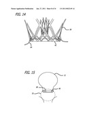 METHODS AND DEVICES FOR TREATMENT OF VASCULAR DEFECTS diagram and image