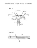 METHODS AND DEVICES FOR TREATMENT OF VASCULAR DEFECTS diagram and image