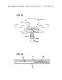 METHODS AND DEVICES FOR TREATMENT OF VASCULAR DEFECTS diagram and image