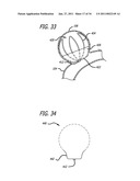 METHODS AND DEVICES FOR TREATMENT OF VASCULAR DEFECTS diagram and image