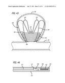 METHODS AND DEVICES FOR TREATMENT OF VASCULAR DEFECTS diagram and image