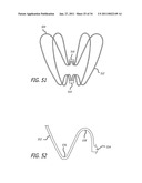 METHODS AND DEVICES FOR TREATMENT OF VASCULAR DEFECTS diagram and image