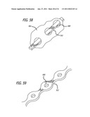 METHODS AND DEVICES FOR TREATMENT OF VASCULAR DEFECTS diagram and image