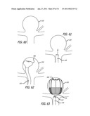 METHODS AND DEVICES FOR TREATMENT OF VASCULAR DEFECTS diagram and image