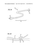 METHODS AND DEVICES FOR TREATMENT OF VASCULAR DEFECTS diagram and image