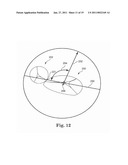 Annuloplasty Device for Tricuspid Valve Repair diagram and image