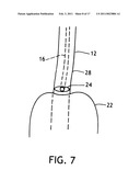 Subglottic Suctioning System diagram and image