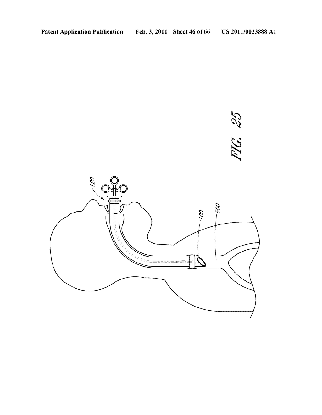 METHODS FOR REMOVING DEBRIS FROM MEDICAL TUBES - diagram, schematic, and image 47