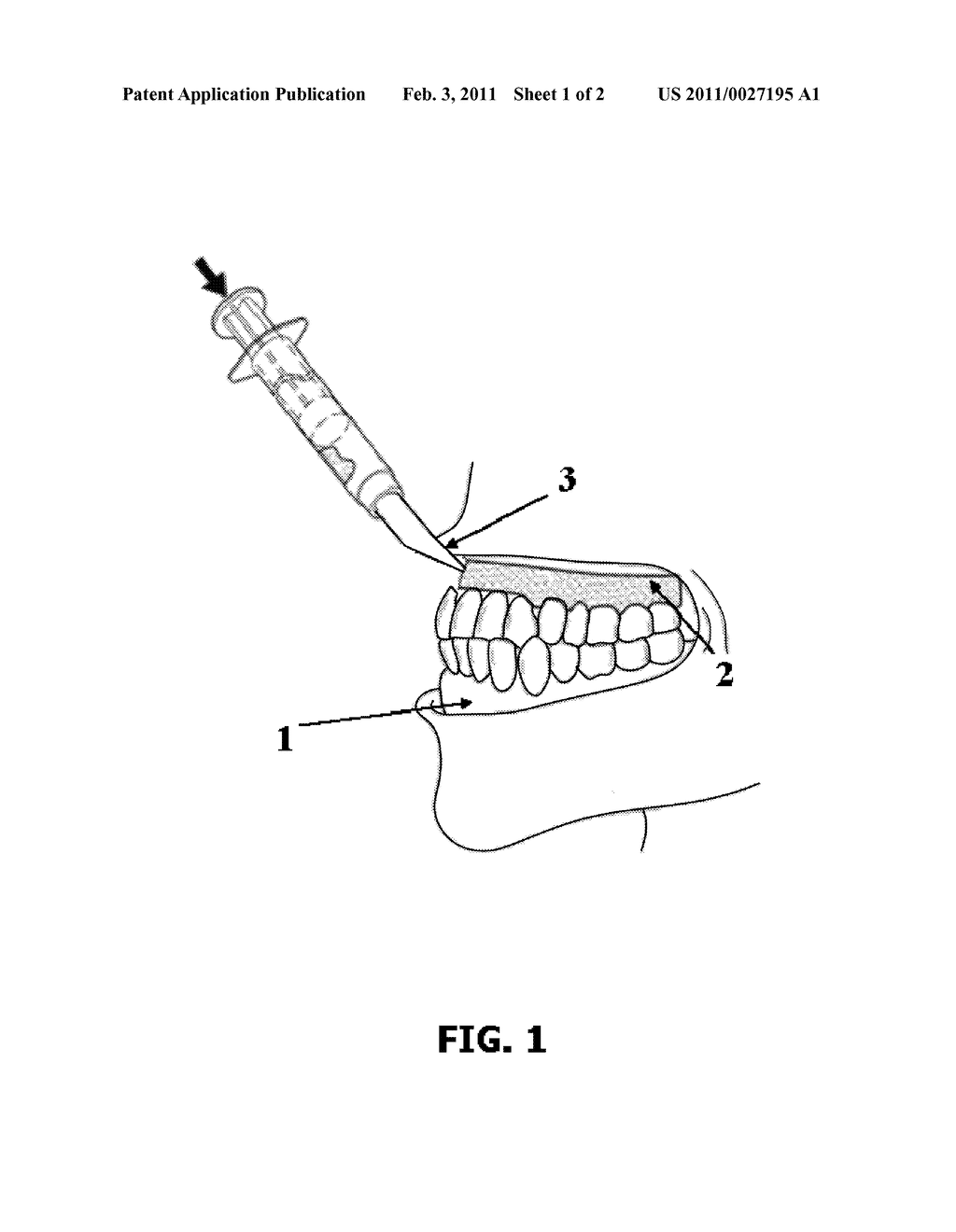 COMPOSITION FOR DENTAL BARRIER COMPRISING AT LEAST ONE MONOMER, AT LEAST ONE POLYMERIZATION INITIATING SYSTEM, AND AT LEAST ONE INDICATOR ENABLING THE POLYMERIZATION REACTION TO BE MONITORED - diagram, schematic, and image 02