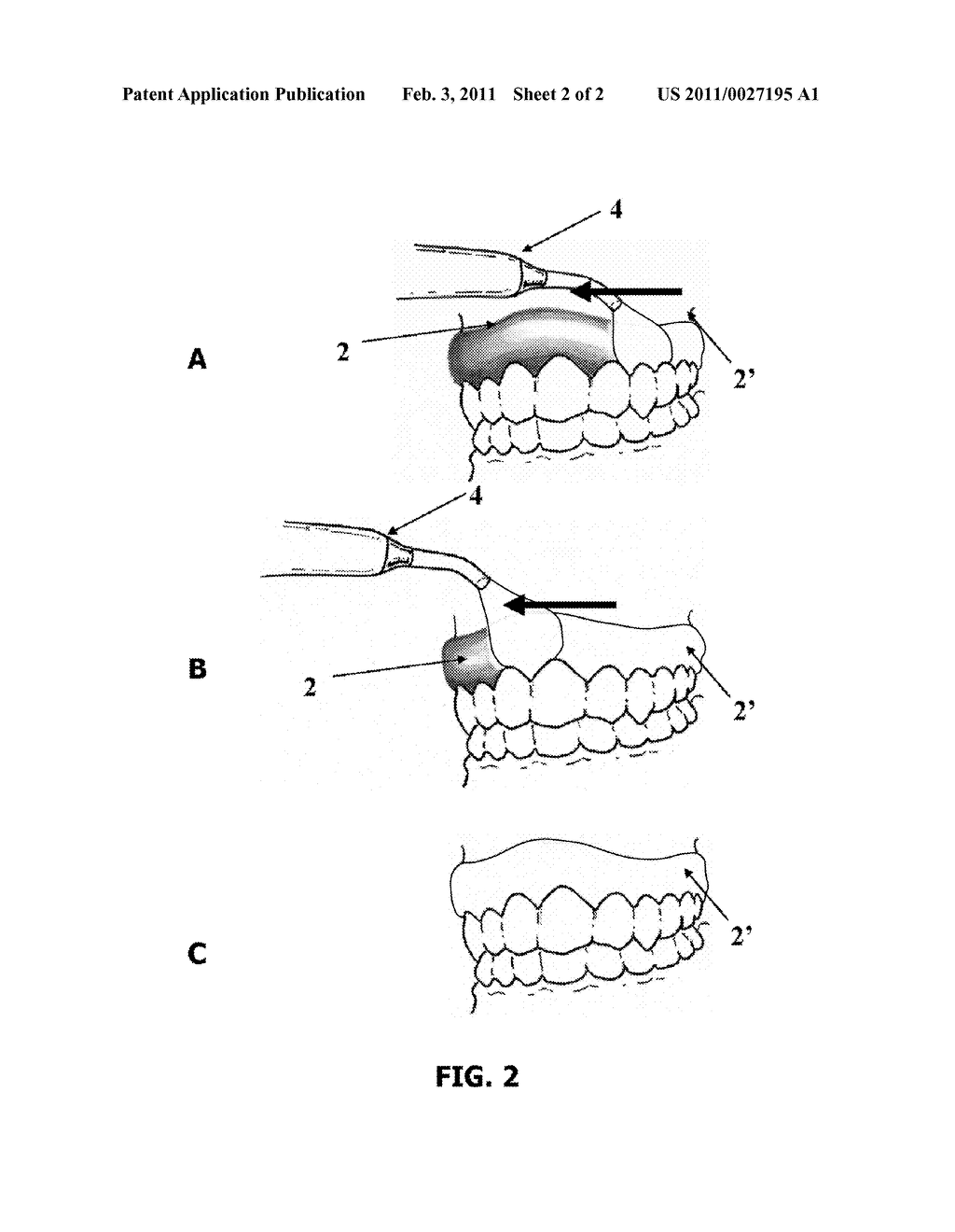 COMPOSITION FOR DENTAL BARRIER COMPRISING AT LEAST ONE MONOMER, AT LEAST ONE POLYMERIZATION INITIATING SYSTEM, AND AT LEAST ONE INDICATOR ENABLING THE POLYMERIZATION REACTION TO BE MONITORED - diagram, schematic, and image 03