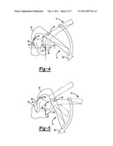 DENTAL PLIERS WITH ADJUSTABLE BUMPER diagram and image