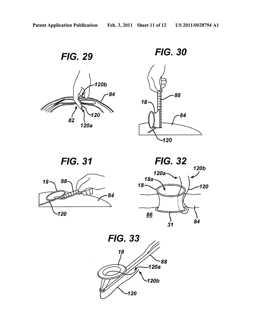 METHODS AND DEVICES FOR PROVIDING ACCESS INTO A BODY CAVITY - diagram, schematic, and image 12