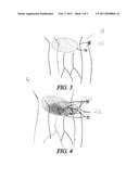 Use of Heat Sensitive Color Changing Formula to Detect and Prevent the Onset of Decubitus Ulcers diagram and image