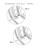 METHODS AND APPARATUSES FOR ENDOSCOPIC RETROGRADE CHOLANGIOPANCREATOGRAPHY diagram and image