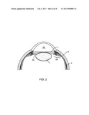 GLAUCOMA TREATMENT DEVICE diagram and image