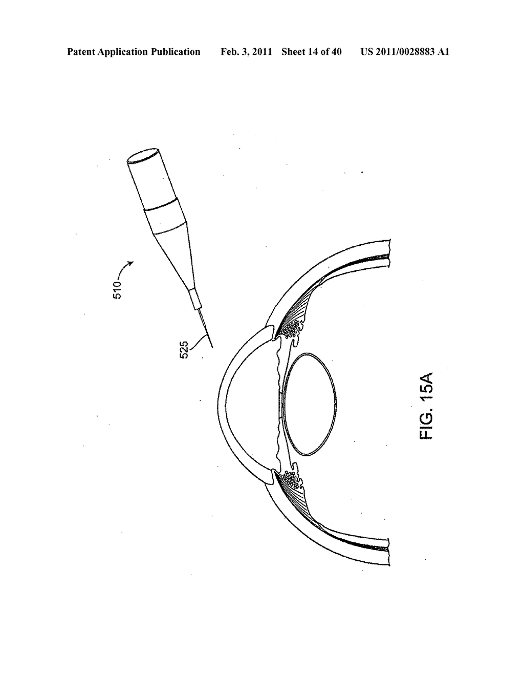 GLAUCOMA TREATMENT DEVICE - diagram, schematic, and image 15