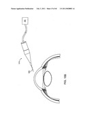 GLAUCOMA TREATMENT DEVICE diagram and image