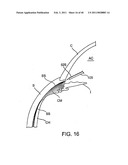 GLAUCOMA TREATMENT DEVICE diagram and image