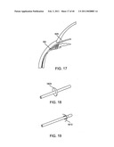 GLAUCOMA TREATMENT DEVICE diagram and image