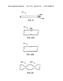 GLAUCOMA TREATMENT DEVICE diagram and image