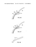 GLAUCOMA TREATMENT DEVICE diagram and image