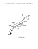 GLAUCOMA TREATMENT DEVICE diagram and image