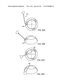 GLAUCOMA TREATMENT DEVICE diagram and image