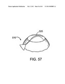 GLAUCOMA TREATMENT DEVICE diagram and image