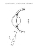 GLAUCOMA TREATMENT DEVICE diagram and image