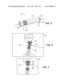 BONE VOID FILLING TUBE AND SHEAR MECHANISM diagram and image