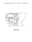 METHODS AND DEVICES FOR TREATMENT OF MIGRAINES diagram and image