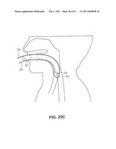 METHODS AND DEVICES FOR TREATMENT OF MIGRAINES diagram and image