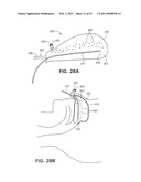 METHODS AND DEVICES FOR TREATMENT OF MIGRAINES diagram and image