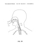 METHODS AND DEVICES FOR TREATMENT OF MIGRAINES diagram and image