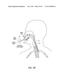 METHODS AND DEVICES FOR TREATMENT OF MIGRAINES diagram and image