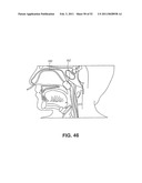 METHODS AND DEVICES FOR TREATMENT OF MIGRAINES diagram and image