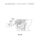 METHODS AND DEVICES FOR TREATMENT OF MIGRAINES diagram and image