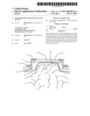 Decompressive Craniotomy fixation device diagram and image