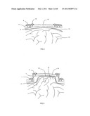 Decompressive Craniotomy fixation device diagram and image