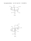 Decompressive Craniotomy fixation device diagram and image