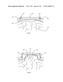 Decompressive Craniotomy fixation device diagram and image