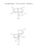 Decompressive Craniotomy fixation device diagram and image