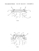 Decompressive Craniotomy fixation device diagram and image