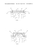 Decompressive Craniotomy fixation device diagram and image