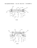 Decompressive Craniotomy fixation device diagram and image