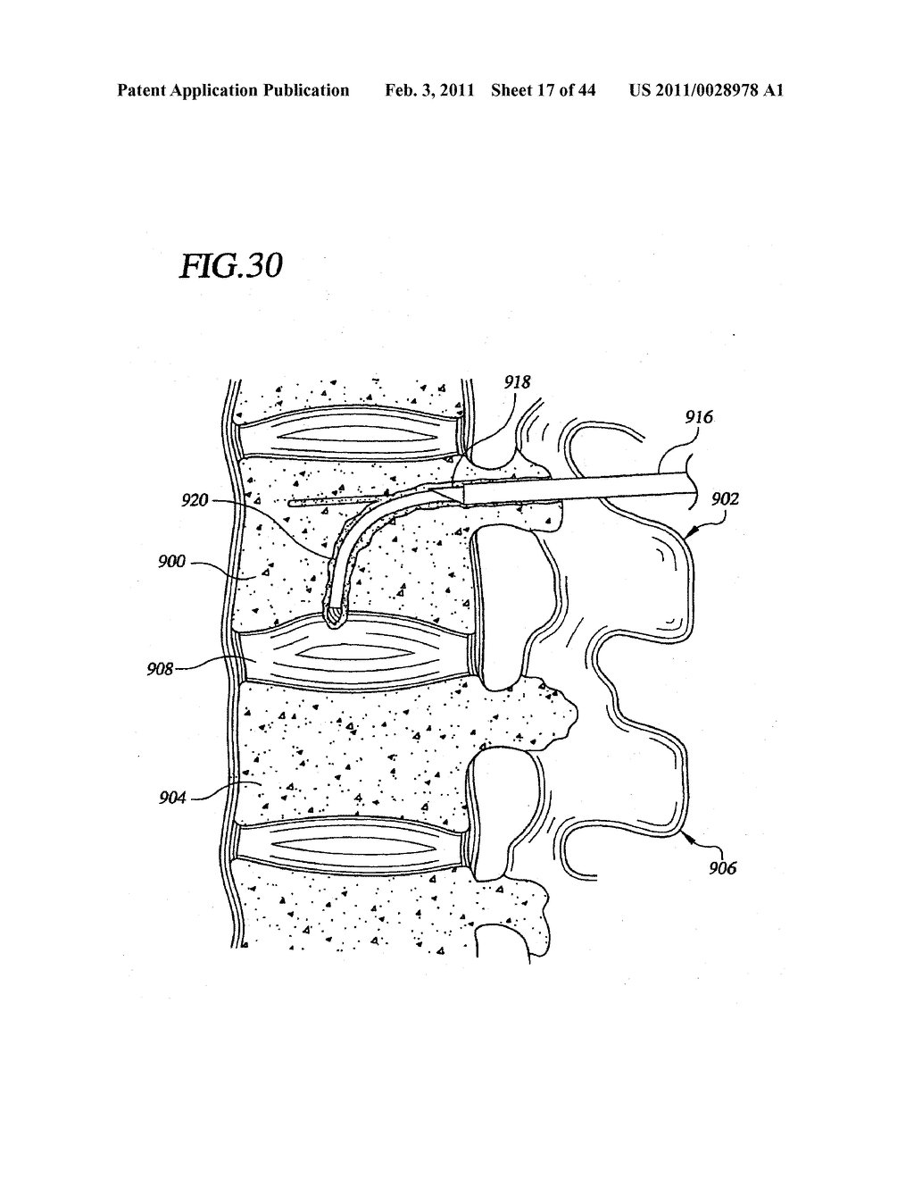 Transpedicular Intervertebral Disk Access Methods and Devices - diagram, schematic, and image 18