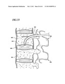 Transpedicular Intervertebral Disk Access Methods and Devices diagram and image