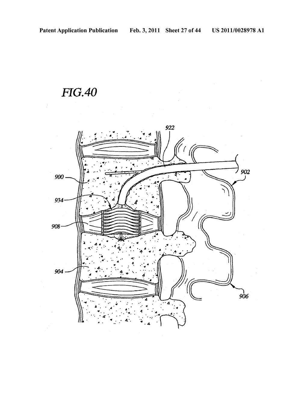 Transpedicular Intervertebral Disk Access Methods and Devices - diagram, schematic, and image 28